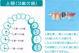 上顎（３歯欠損）  上顎左第一、第二小臼歯と第二大臼歯（４５７）欠損です。 このような飛び石欠損もMTCでは得意としています。間に嵌り込んで落ちてきません。  