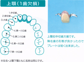 上顎（１歯欠損）   上顎右中切歯欠損です。 隣在歯の形態が良かったので プレートは短く出来ました。  