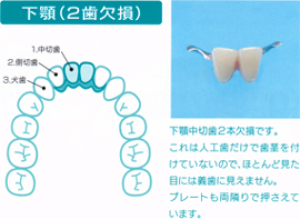 下顎（２歯欠損）  下顎中切歯２本欠損です。これは人工歯だけで歯茎を付けていないので、ほとんど見た目には義歯に見えません。 プレートも両隣りで押さえています。  