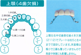 上顎（４歯欠損）  上顎左犬歯から奥の第一大臼歯まで４歯欠損（３４５６）です。 プレートは、後ろの７で押さえて前方は右上２までに留めています。  