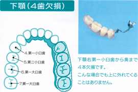 下顎（４歯欠損）  下顎右第一小臼歯から奥まで４本欠損です。 こんな場合でも上に外れてくることはありません。  