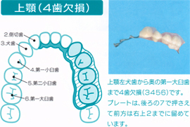 上顎（４歯欠損）  上顎左右中切歯側切歯４本欠損（２１１２）でプレートは右５と左４まで設計しています。床面積は極少で口蓋も覆っていませんので発音や味覚にも影響しません。  