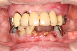 女性
両側遊離端 MTC