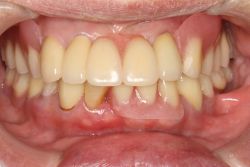 女性両側遊離端 MTC