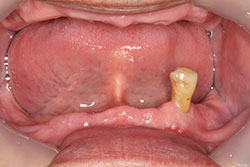 男性
総義歯 MTC