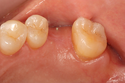 中間欠損（１・２本）/３０代女性