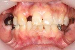 女性
中間欠損 MTC