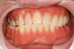 女性
総義歯 Full