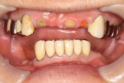 男性
両側遊離端 MTC