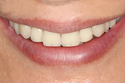 女性総義歯 Full