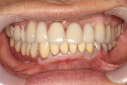 男性両側遊離端 MTC