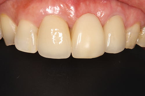 中間欠損（１・２本）
