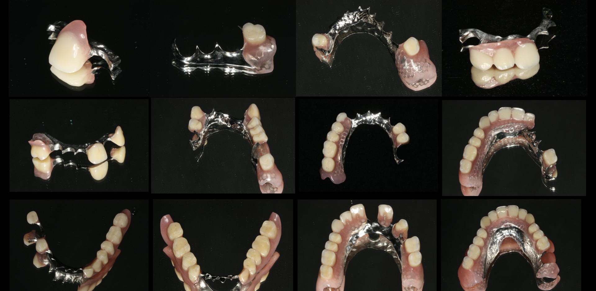 上顎（１歯欠損）