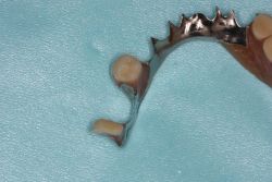 人工歯交換/作業前