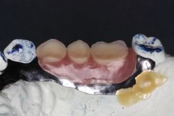 人工歯交換/作業前