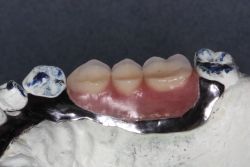 人工歯交換/作業後