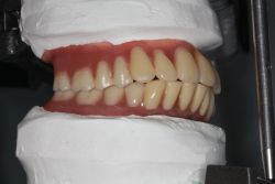 人工歯移動/作業後