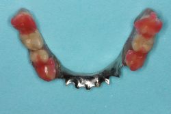 人工歯挙上/作業前