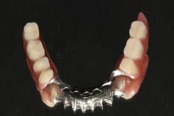 人工歯挙上/作業後