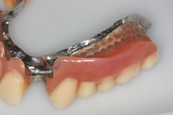 デンチャースペース/作業後