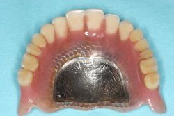 床置き換えレジン/作業前