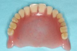 床置き換えレジン/作業後