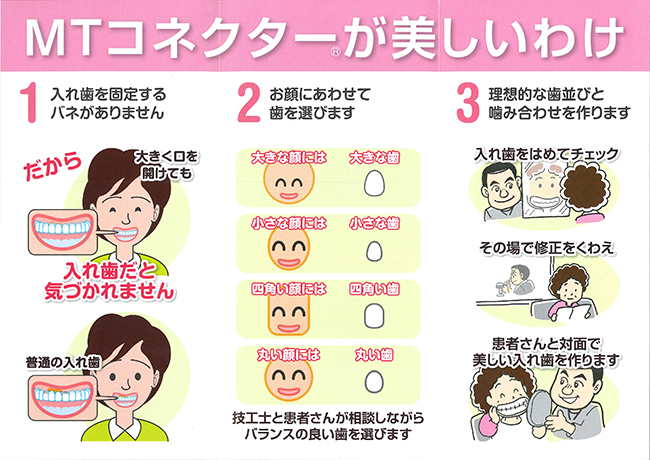 MTコネクターを使用した美しい入れ歯の作成プロセスを説明するイラスト