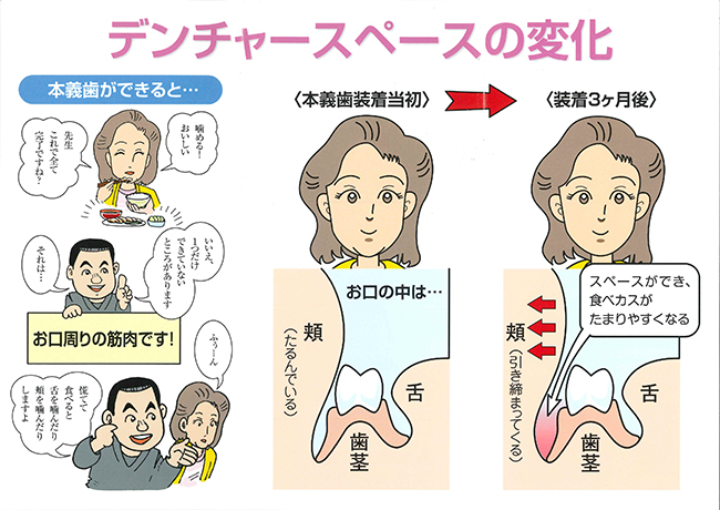 本義歯装着後の変化