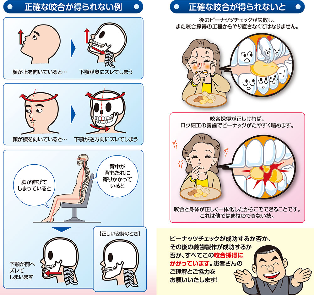 正しい咬合が得られないと