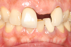 中間欠損（１・２本）