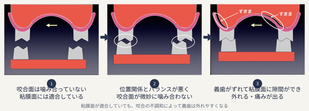粘膜面が適合していても、噛み合わせの不調和から義歯がずれて隙間が生じます